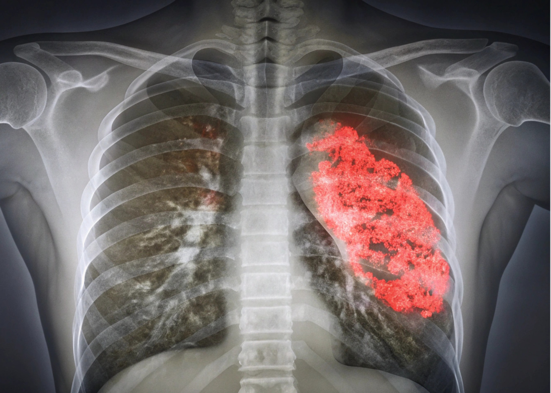 COPD & Pneumonia Expert